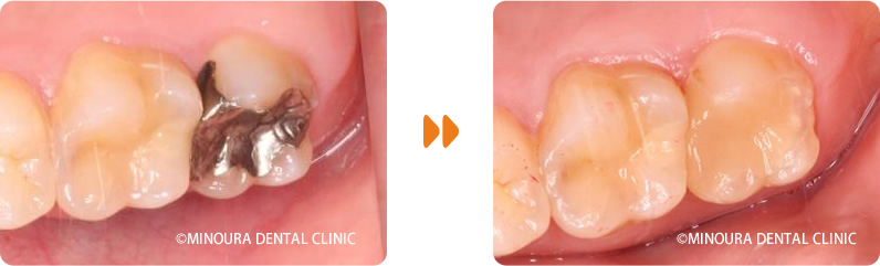奥歯ののEマックスインレー症例